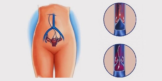 Защо се появяват разширени вени на таза